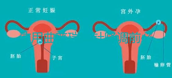 使用曲普瑞林針降調前必看:3大作用對比5大副作用