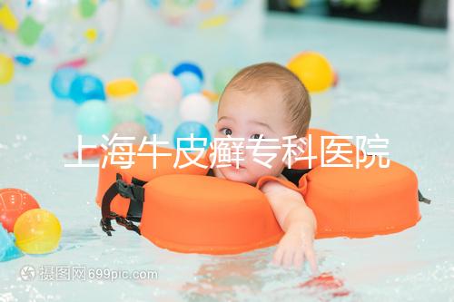 上海牛皮癬?？漆t院