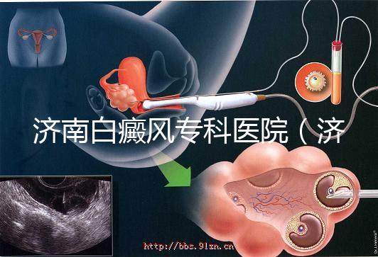 濟南白癜風?？漆t院（濟南白點癲風醫院排名）