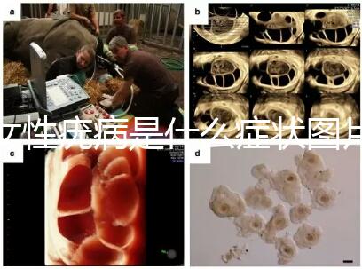 女性疣病是什么癥狀圖片(女生下面長了疙瘩圖片)