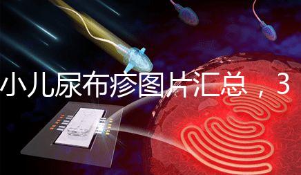 小兒尿布疹圖片匯總，3種類型癥狀大不一樣