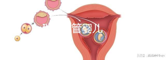 IVF 試管嬰兒