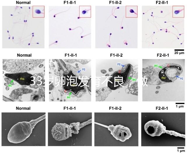 33歲卵泡發(fā)育不良，做試管黃體期促排方案失敗怎么辦？